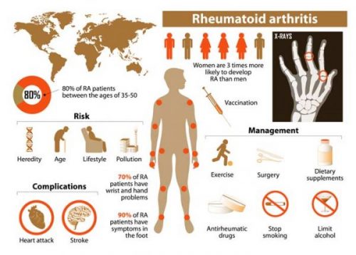 rheumatoid arthritis signs