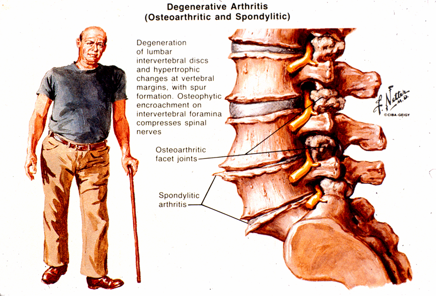 Degenerative Arthritis 