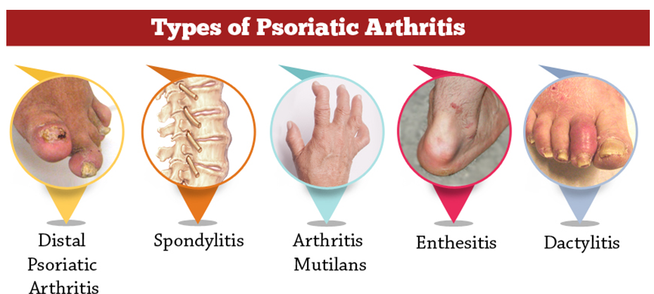 Psoriatic Arthritis Types 