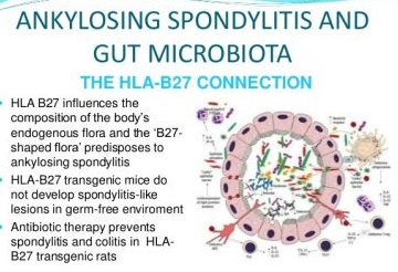 HLA-B27 Ankylosing Spondylitis