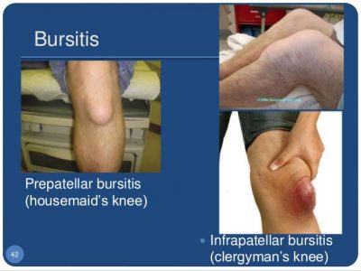bursitis of the knee