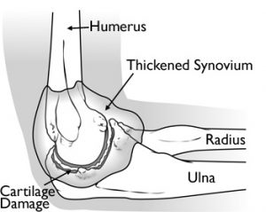 arthritis in the elbows