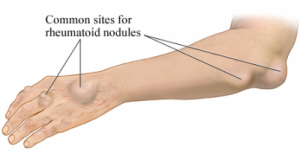 rheumatoid arthritis elbow