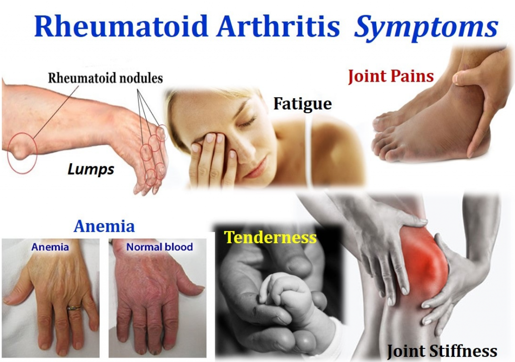 Arthritis Symptoms 