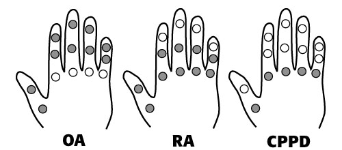types of finger arthritis