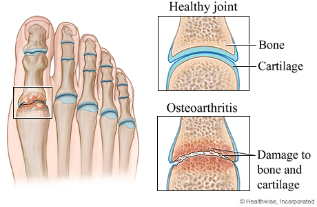 osteoarthritis in feet