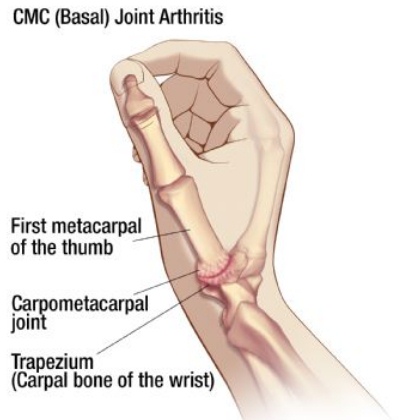 osteoarthritis of thumb
