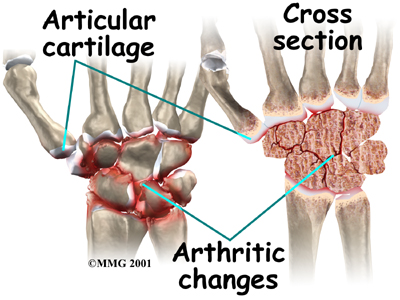 arthritis in the wrist