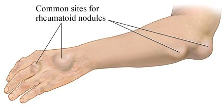 rheumatoid arthritis wrist nodules