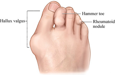 rheumatoid arthritis foot