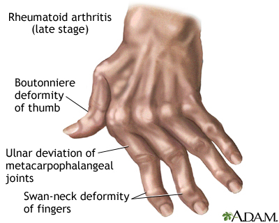 rheumatoid arthritis in thumb