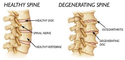 degenerative arthritis symptoms