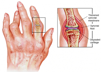 treatment for rheumatoid arthritis in the fingers