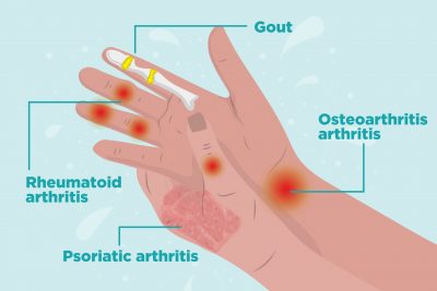 symptoms of arthritis